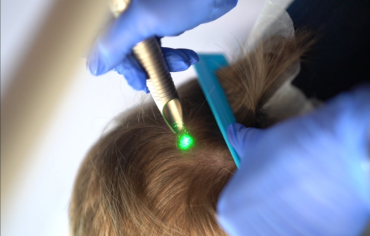 Laserowa stymulacja wzrostu włosów Warszawa –   nowoczesne wsparcie terapii trychologicznej. Jak działa?